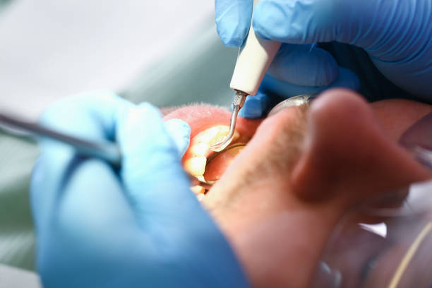 Best Emergency Root Canal Treatment in Murphys, CA